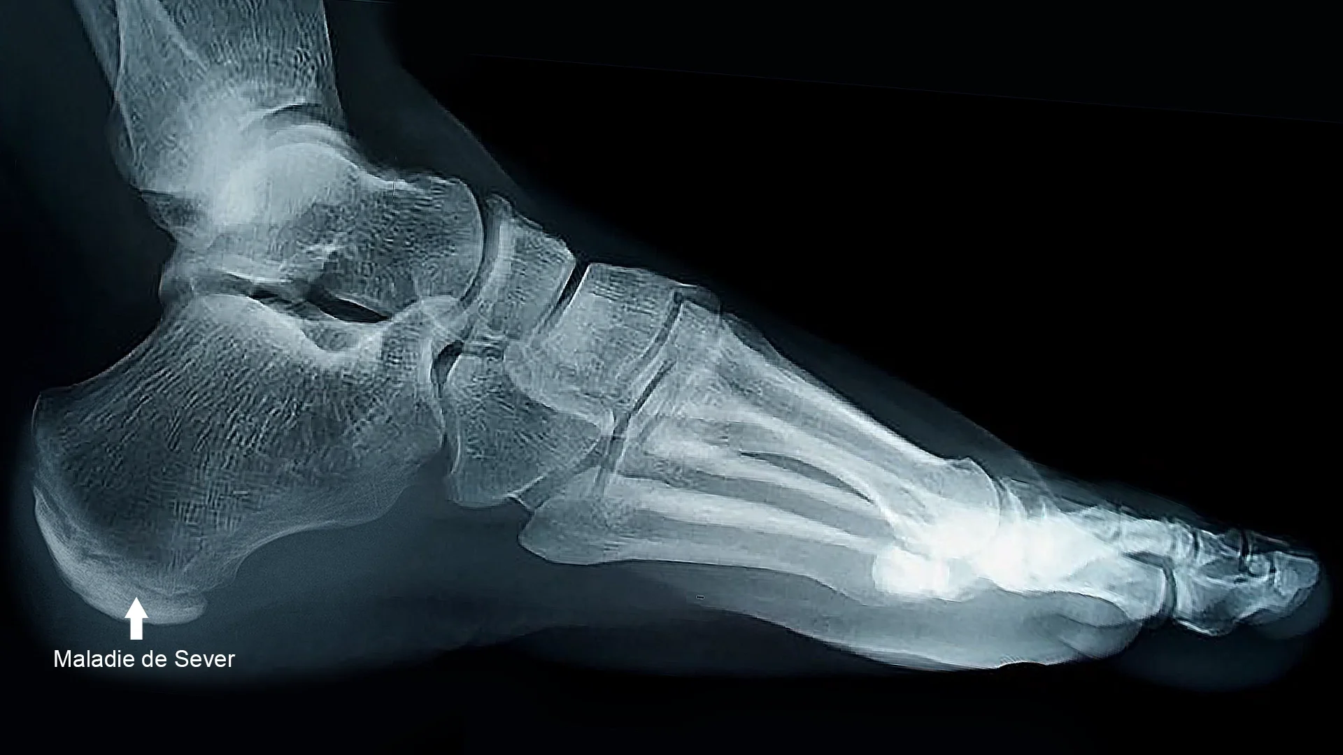 Radiographie d'un pied montrant une maladie de Sever, une maladie osseuse. L'image identifie la zone affectée par une flèche et un texte indiquant "Maladie de Sever".