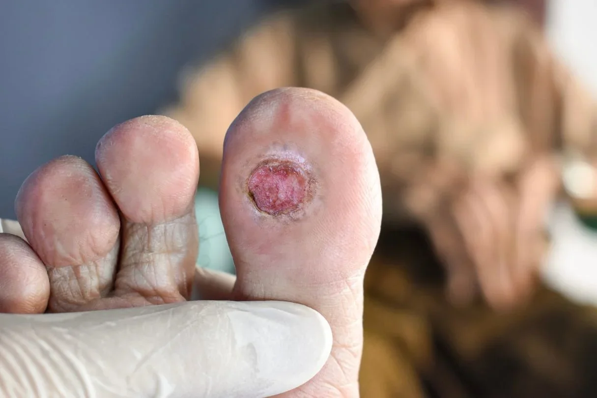 Une main avec un ongle du gros orteil présentant une plaie ou une infection