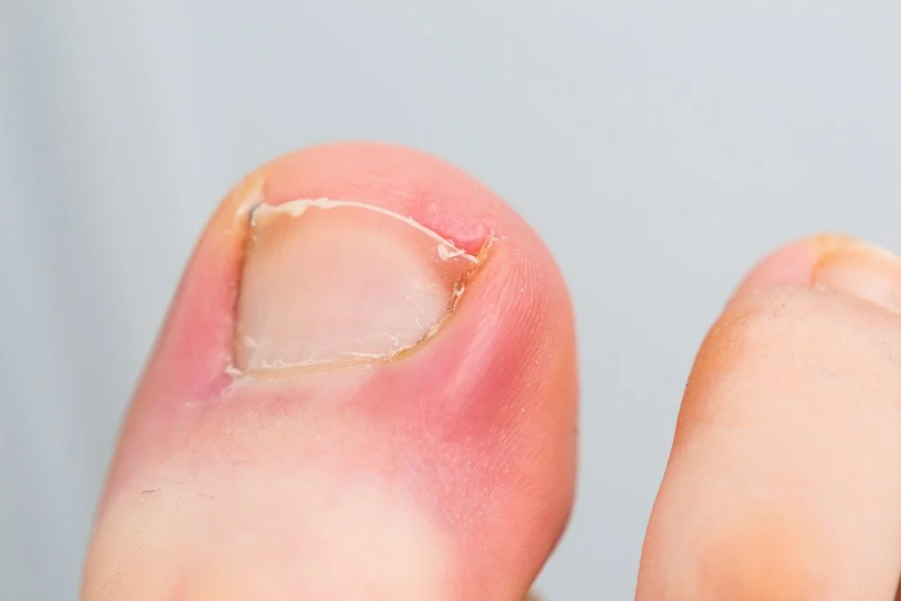 Un gros plan d'un ongle incarné sur un gros orteil, avec la peau irritée autour.