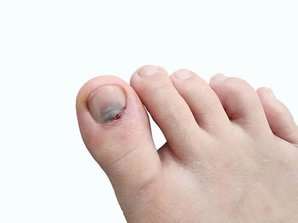 Un gros plan d'un gros orteil avec un ongle noirci et des signes de blessure ou d'infection.
