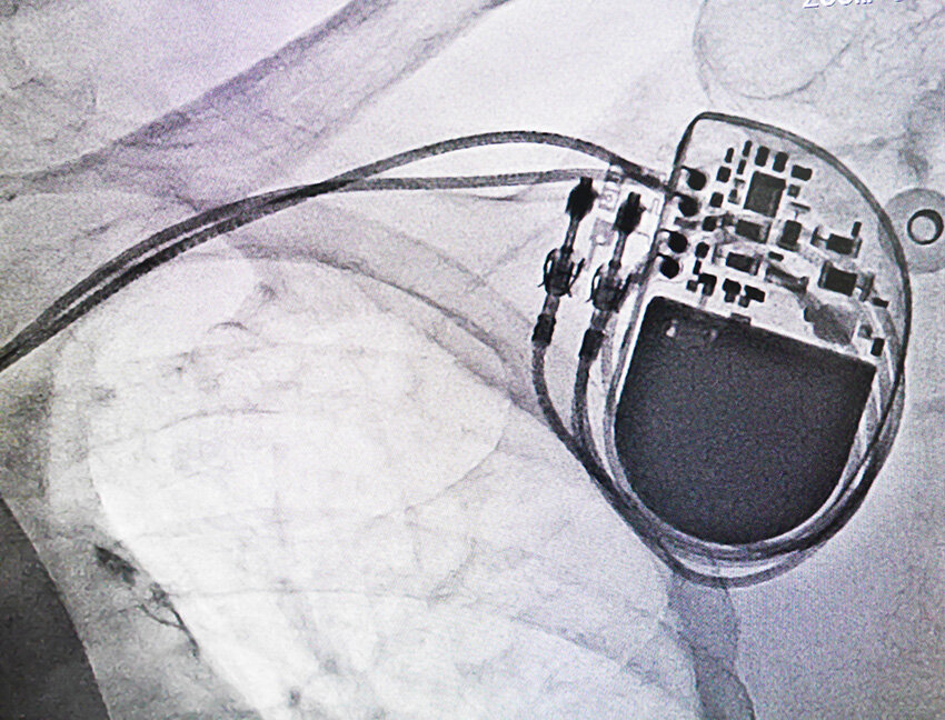 Pacemaker/Device Checks — Dr Young Yu · Cardiologist · Sydney