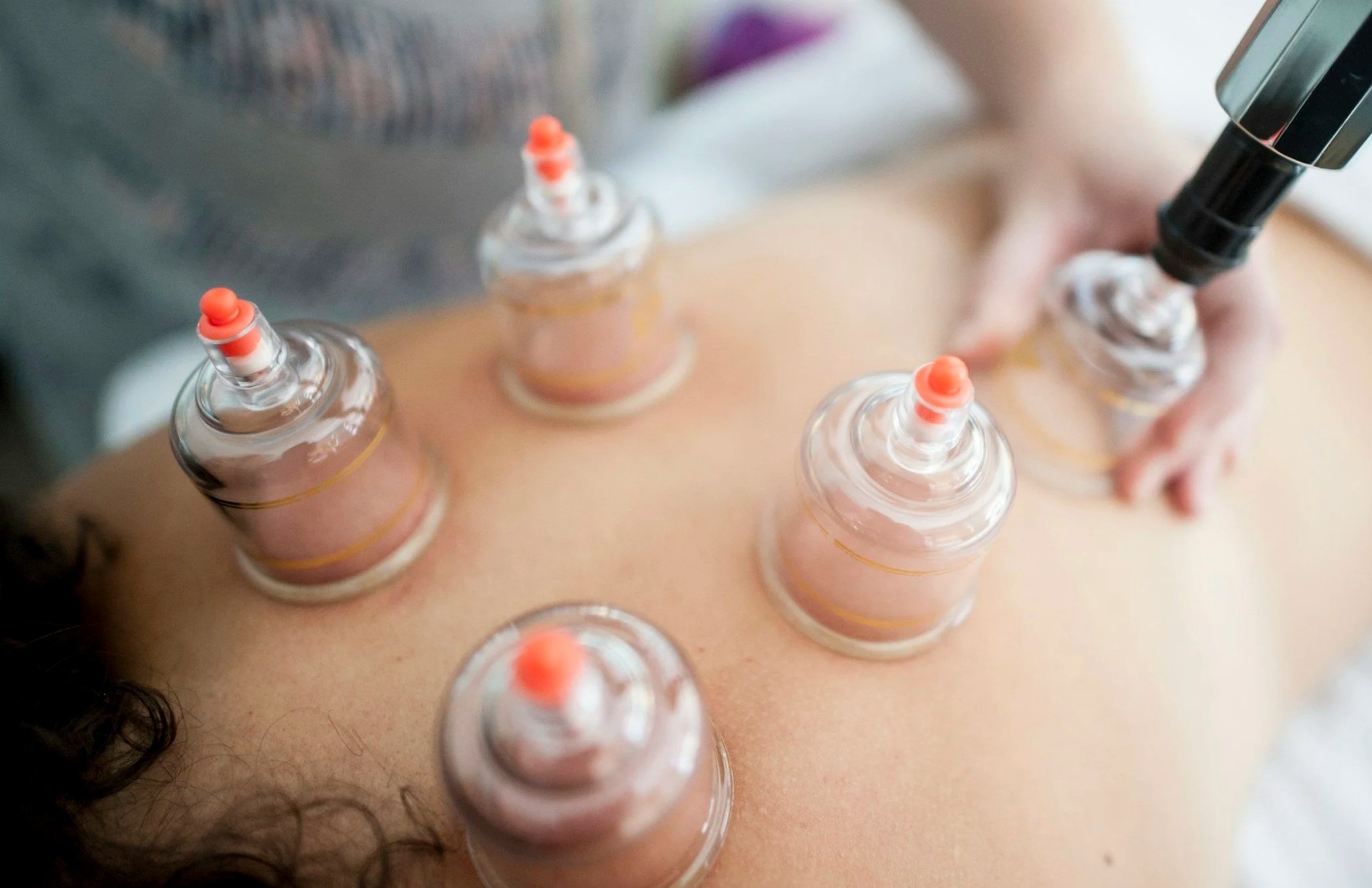 Plastic cups are being applied for a cupping treatment on a person's back. You can see a small amount of dark curly hair of the person receiving the treatment. You can see the provider applying the cups, blurry, in the background.
