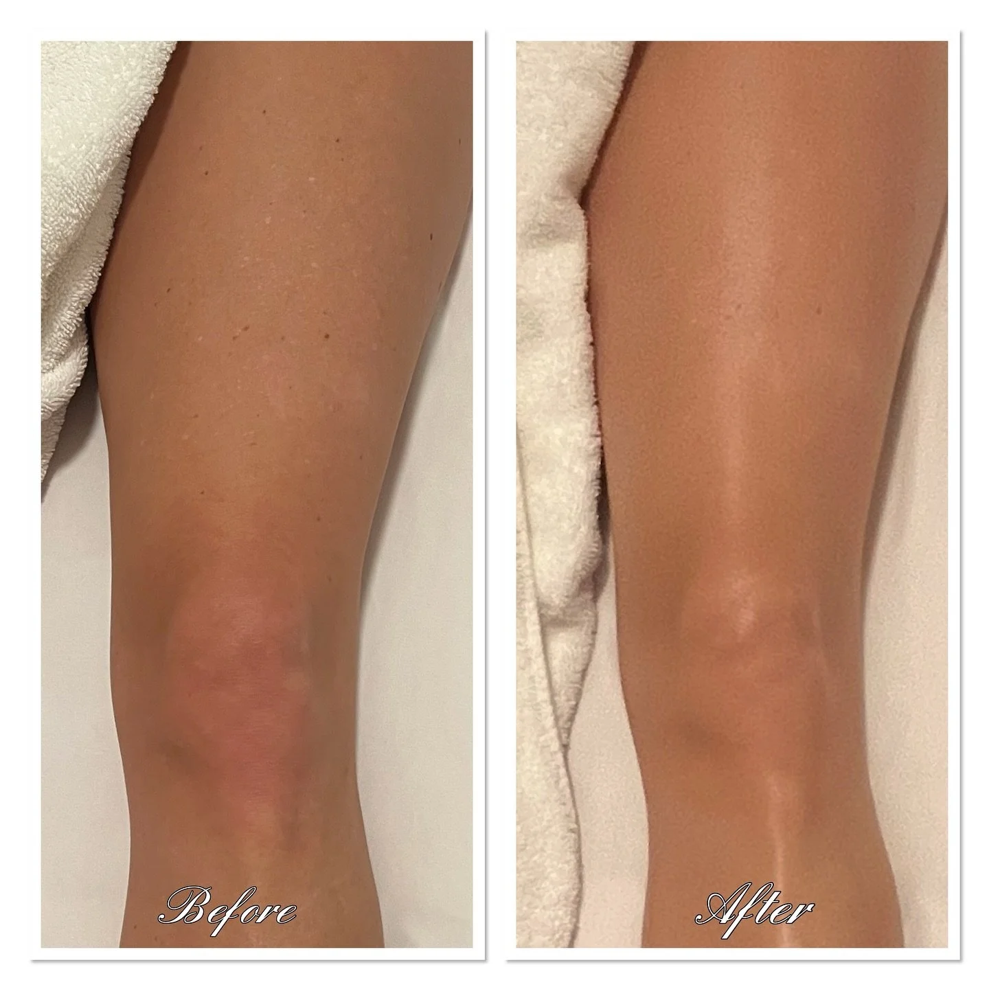 ✨ Maderotherapy Results ✨

Maderotherapy (wood therapy) helps:
🌿 Stimulate lymphatic drainage
🌿 Improve circulation
🌿 Smooth &amp; tone the skin
🌿 Reduce the appearance of cellulite

Your body feels lighter and sculpted.

📍 Available at Le Boudo