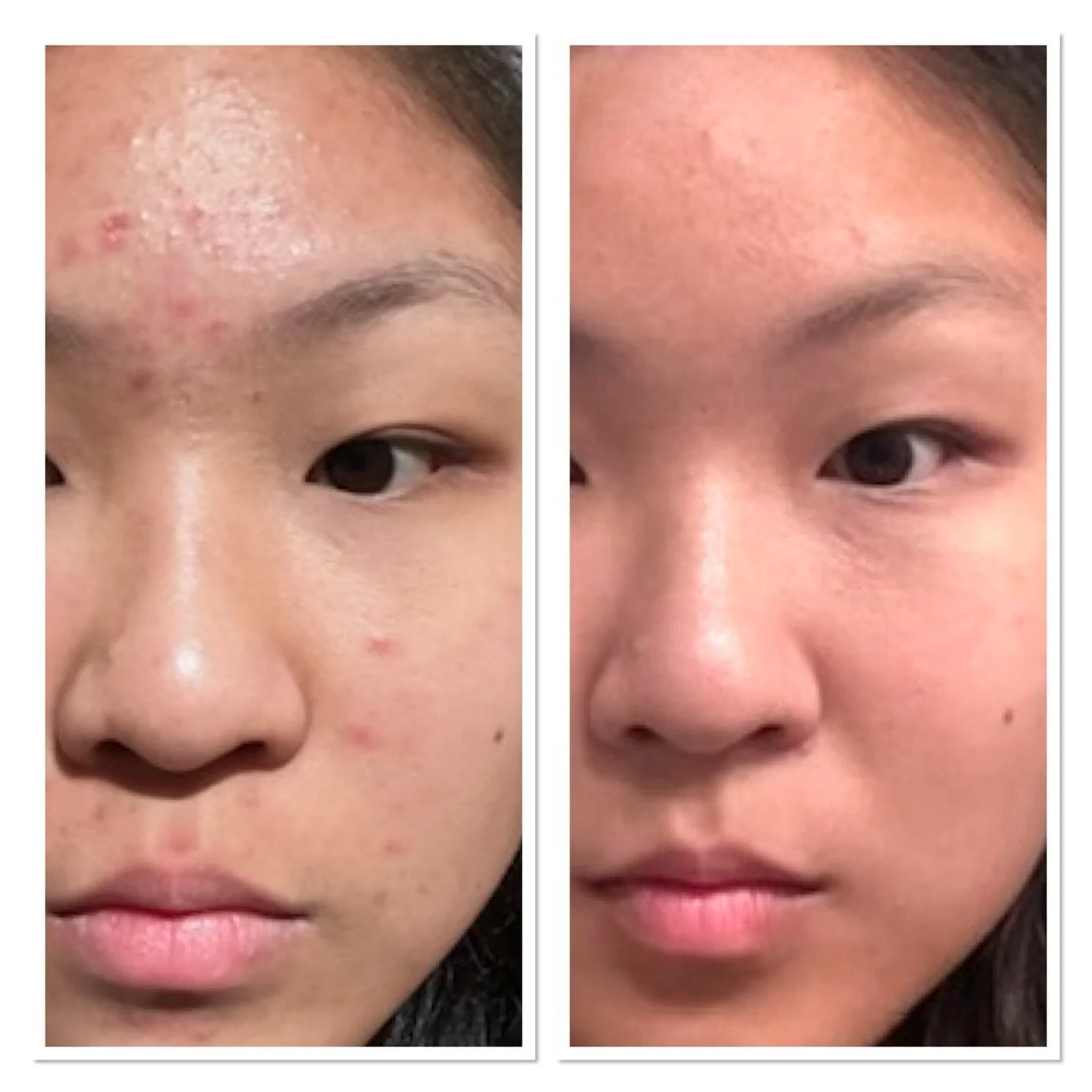 ✨ Clearer skin, calmer complexion ✨
Before &amp; after 

This client came in with active breakouts and inflammation. With consistent treatments, a tailored homecare routine and a gentle approach, her skin is now visibly smoother, clearer and brighter