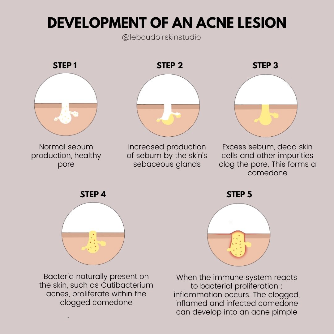 ✨ Understanding Acne ✨

Acne doesn&rsquo;t appear overnight : it develops step by step. What&rsquo;s really happening:

▫️ Step 1: A healthy pore with normal sebum production
▫️ Step 2: Sebaceous glands begin producing excess oil
▫️ Step 3: Sebum, de