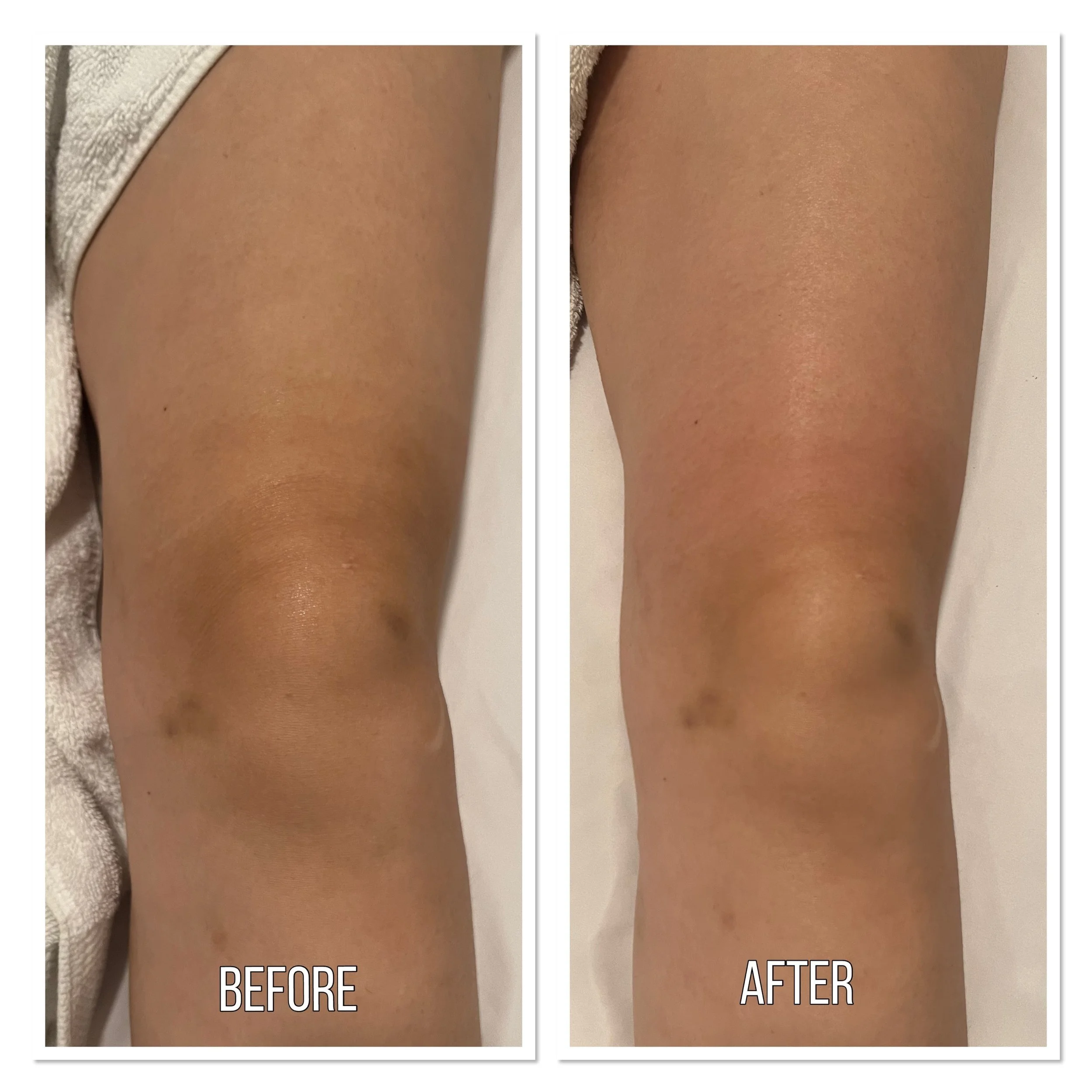 wood therapy NYC, maderotherapy nyc, body sculpting treatment nyc