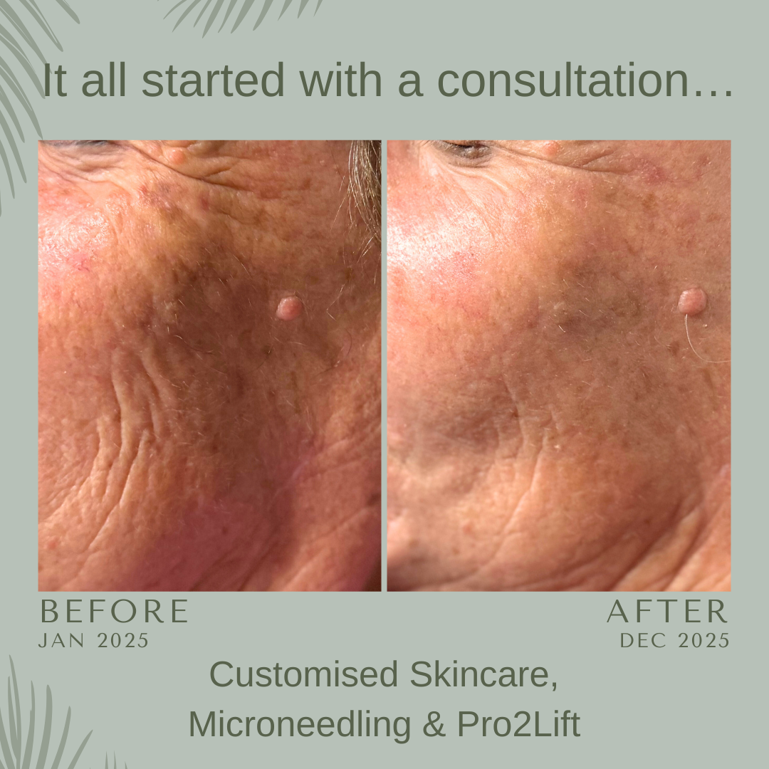 geneo x, micro needling, pigmentation, mature skin, wrinkles, anti ageing, facial,