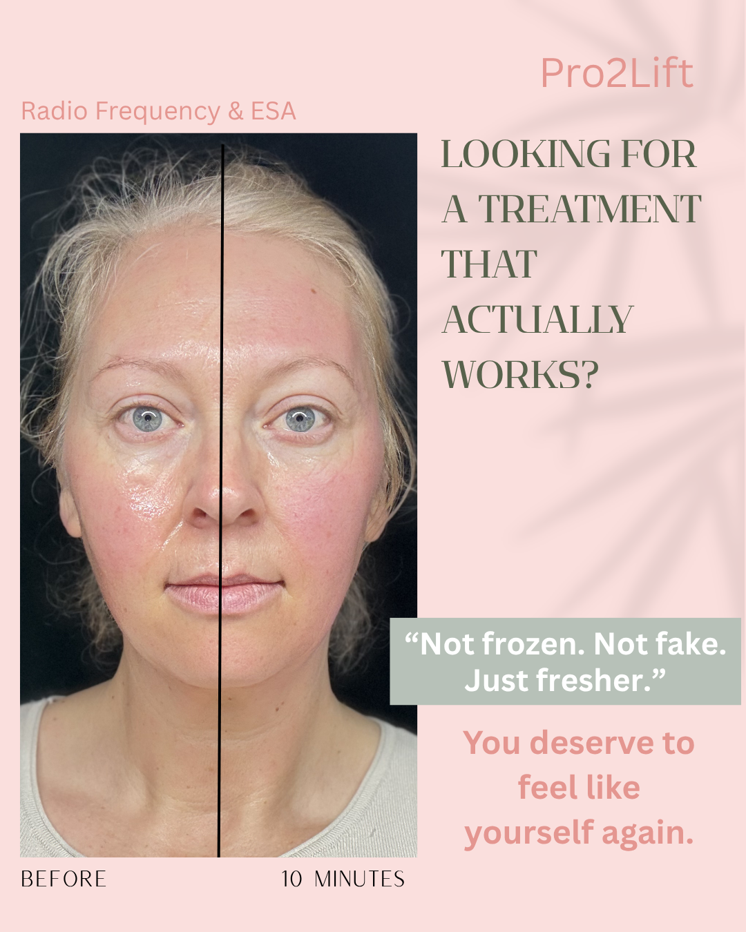 Mel Roberts Glow for Beauty Before after Radio Frequency & ESA.png