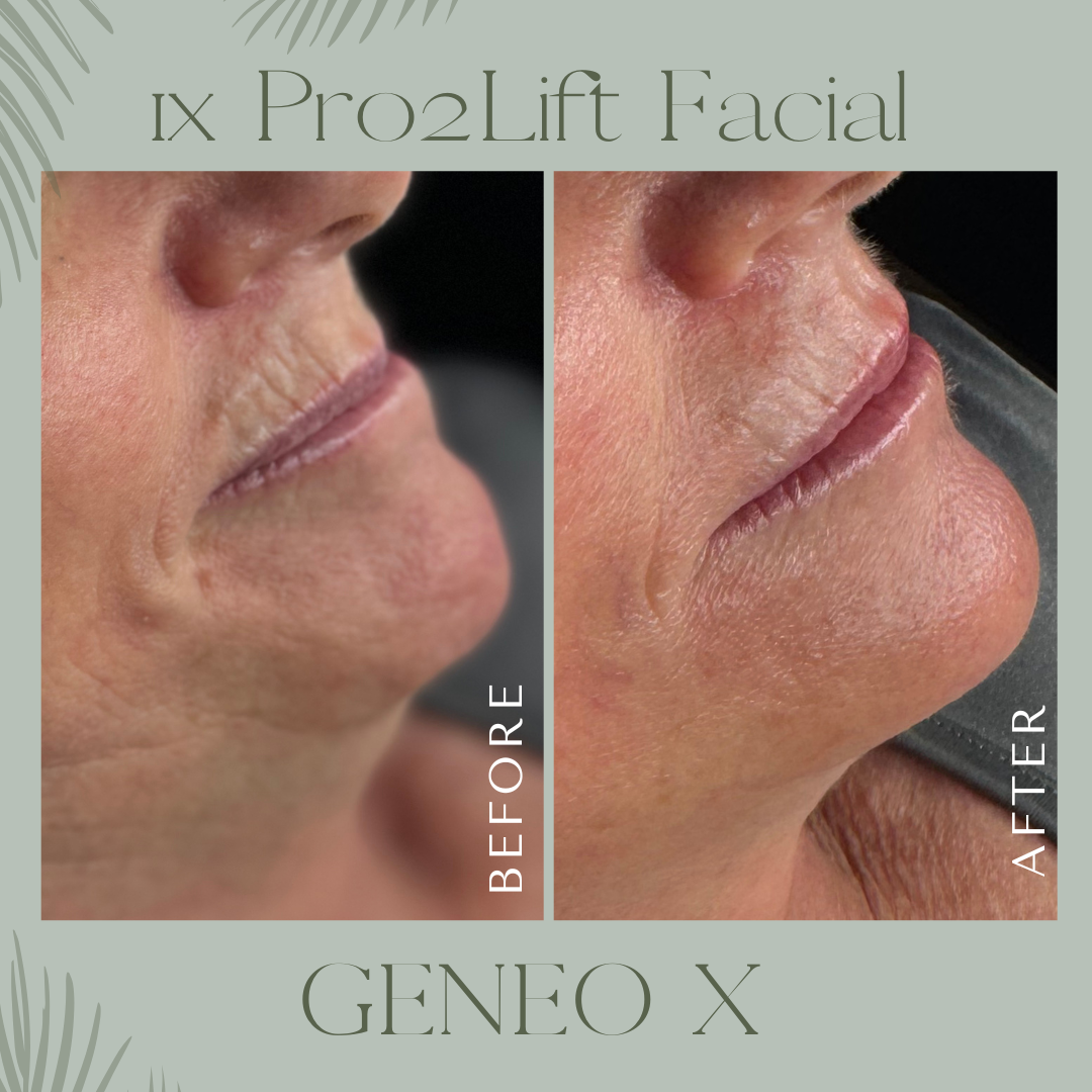 Pro2lift before & after image of less wrinkles on lips and firmer skin
