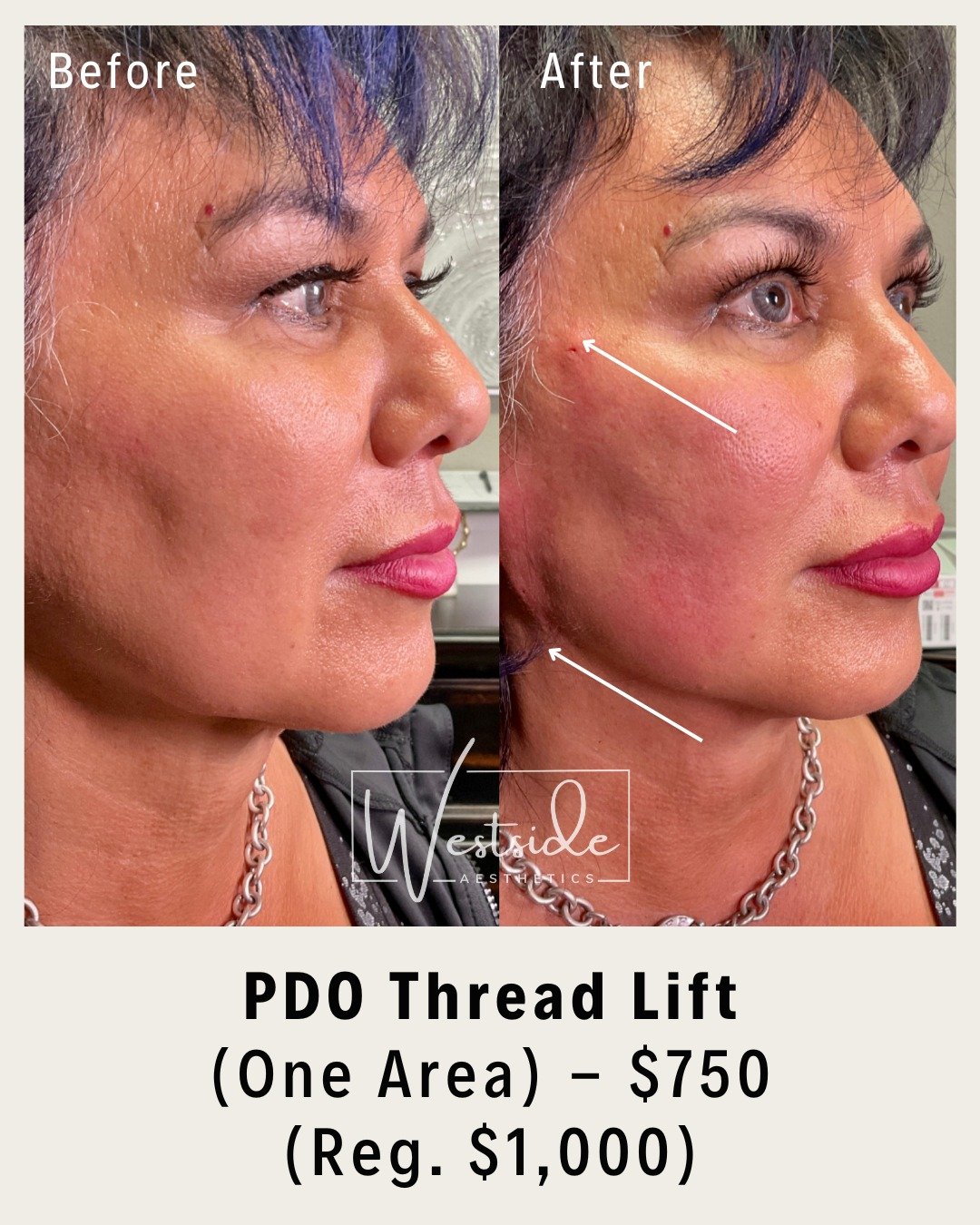 PDO Thread Lift by Wendy