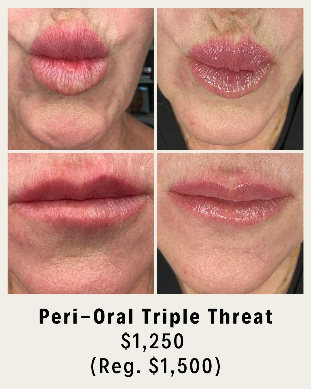Peri-Oral tox, fillers & collagen-boosting threads by Wendy