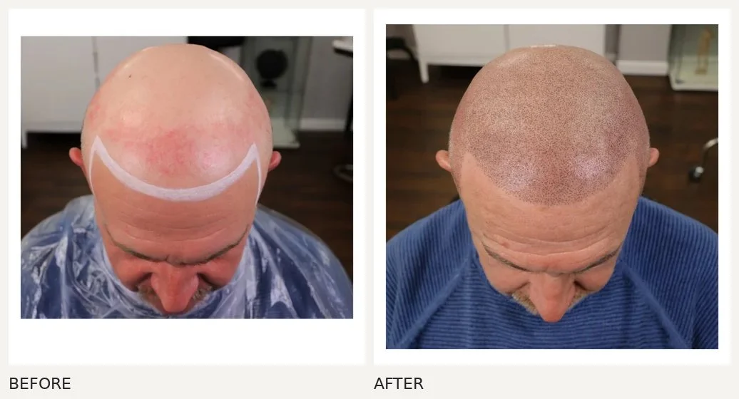 Scalp micropigmentation · Before & After