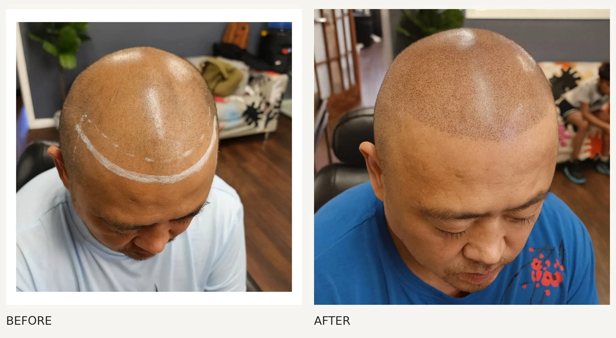 Scalp micropigmentation · Before & After