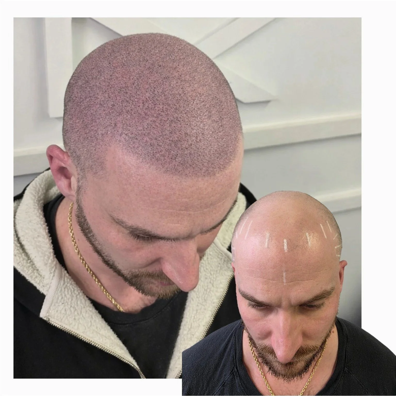 Scalp micropigmentation before and after.