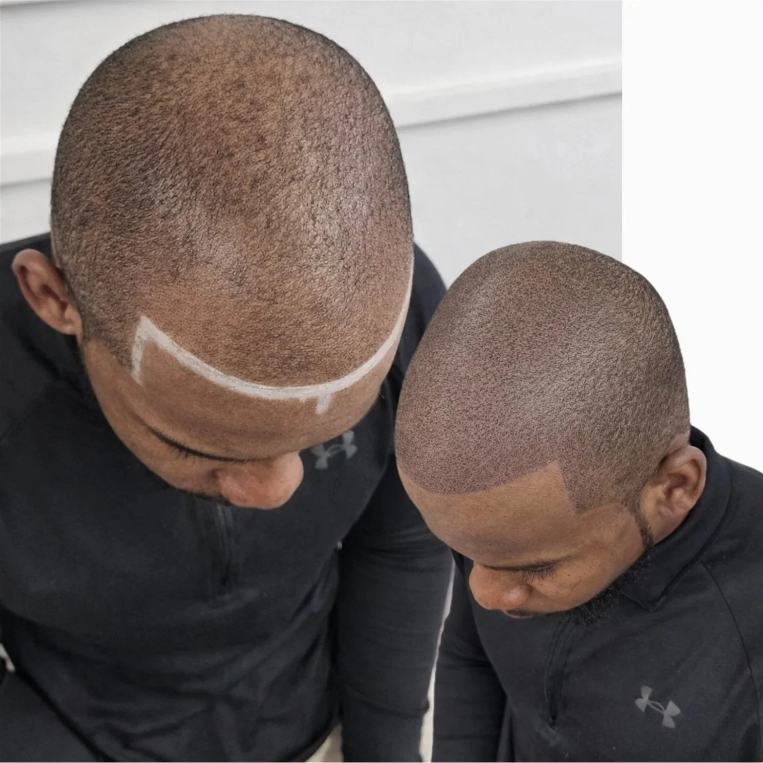 Hairline mapping and scalp micropigmentation result.