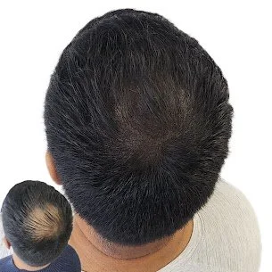 Fuller-Looking Hair Starts with a Personal Plan