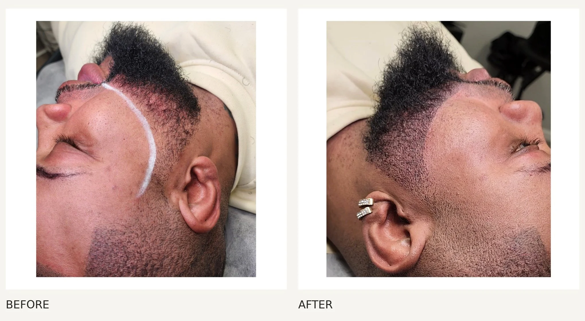 Beard pigmentation before and after at Scalp & Skin Artistry