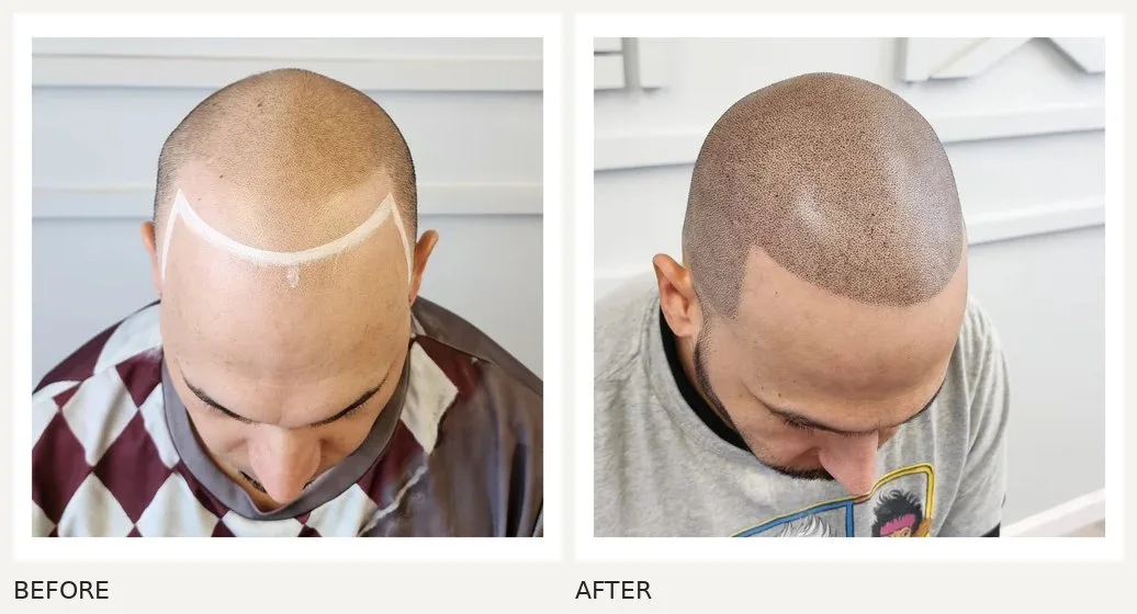 Scalp micropigmentation · Before & After
