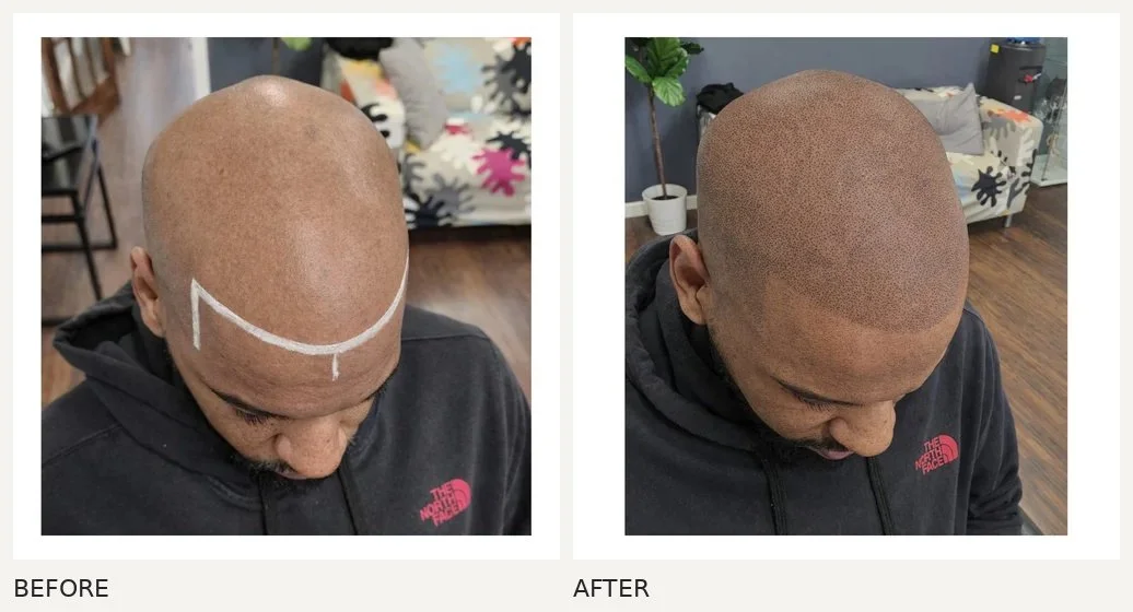 Scalp micropigmentation · Before & After
