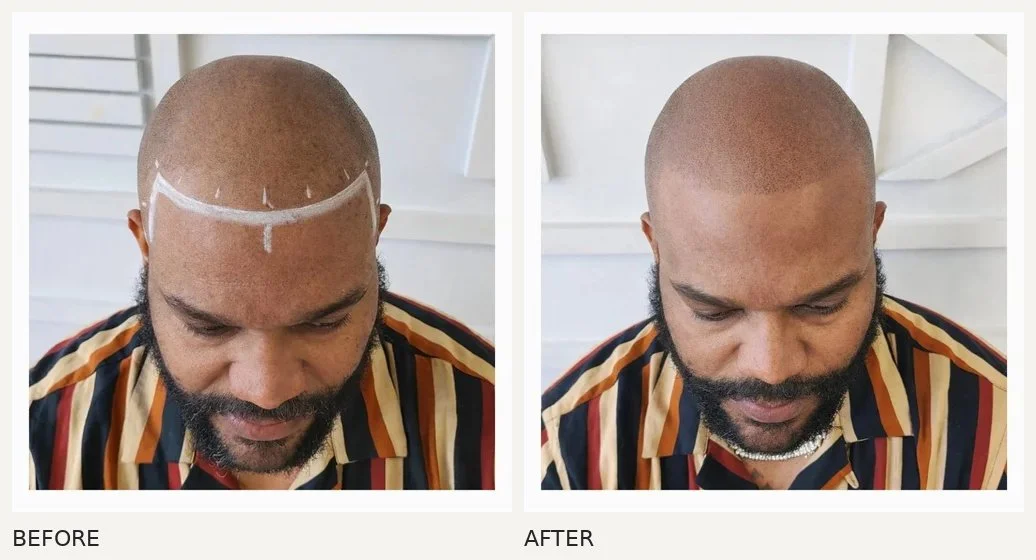 Scalp micropigmentation · Before & After