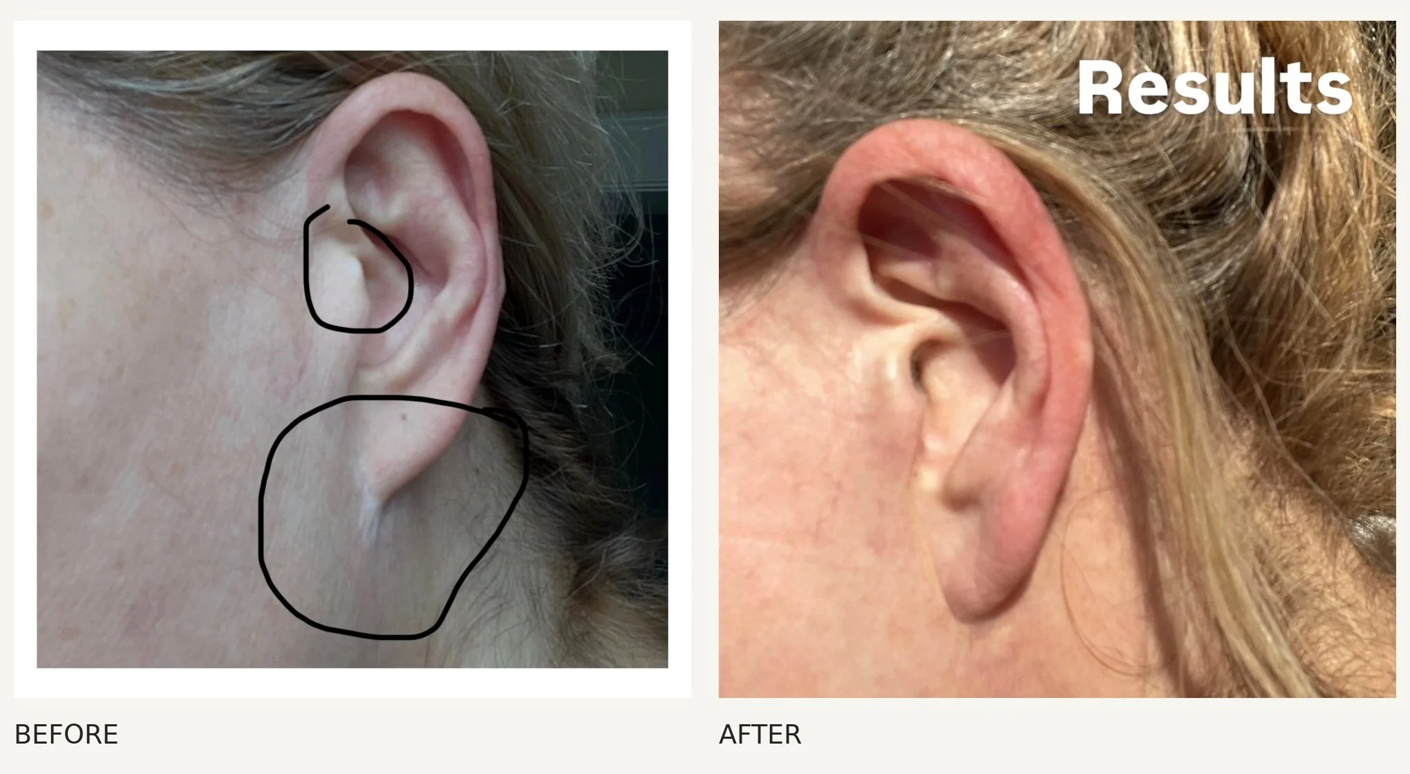 Scar camouflage · Other ear · Before & After
