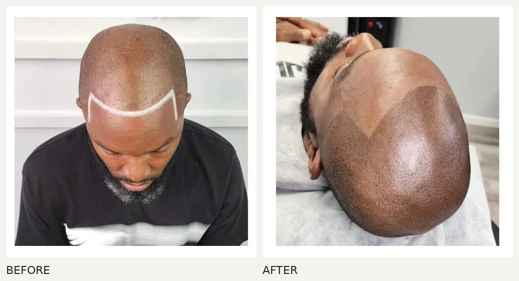 Scalp micropigmentation · Before & After