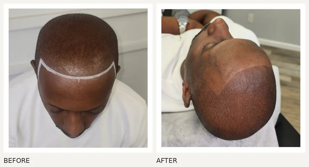 Scalp micropigmentation · Before & After