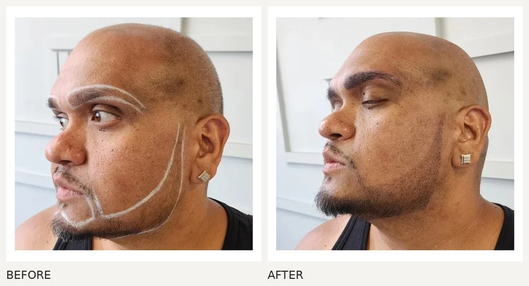 Beard pigmentation · Before & After