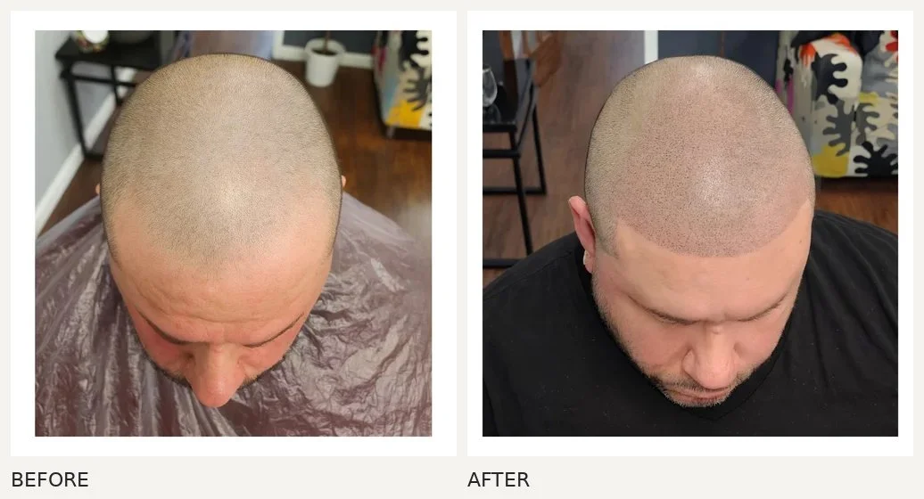 Scalp micropigmentation · Before & After