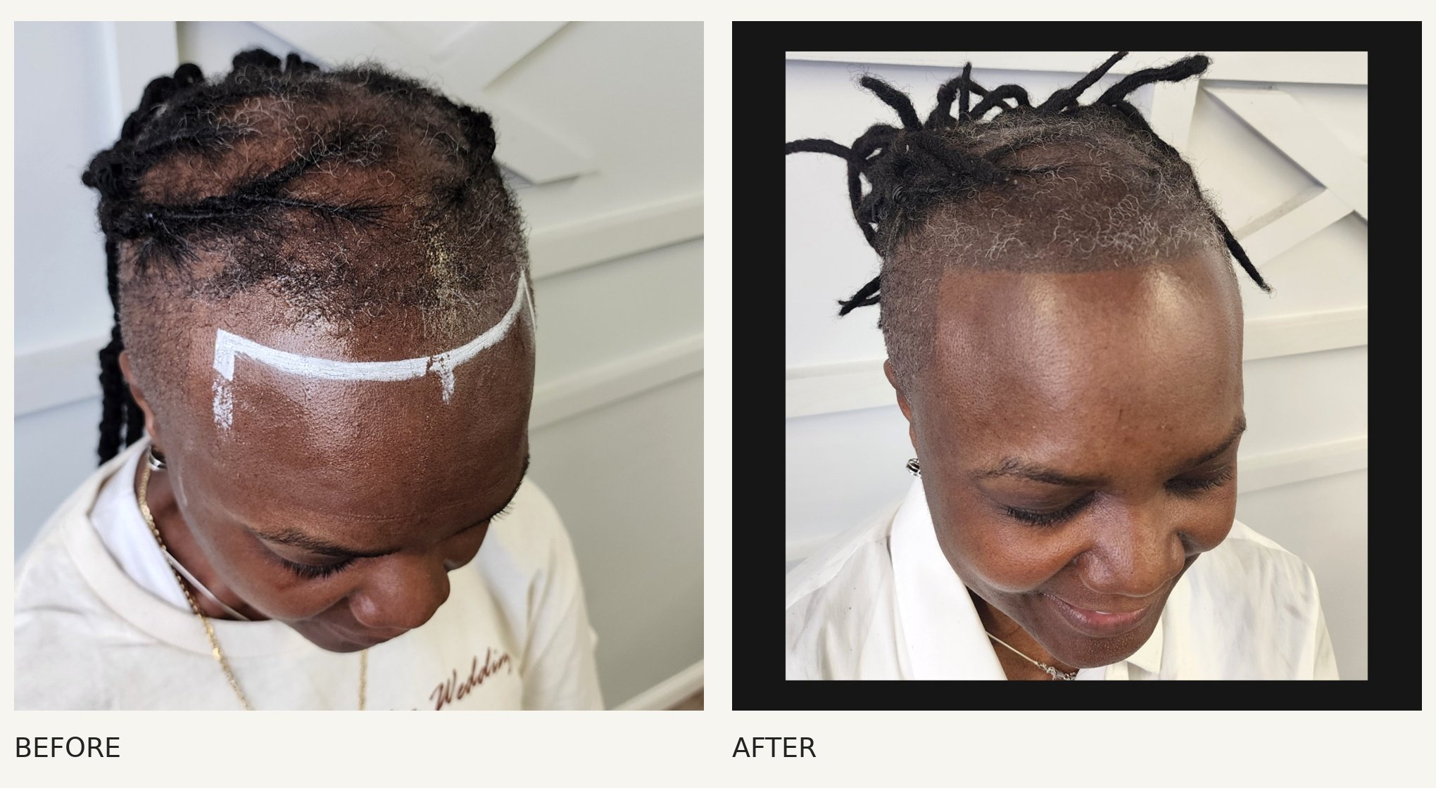 Scalp micropigmentation · Before & After