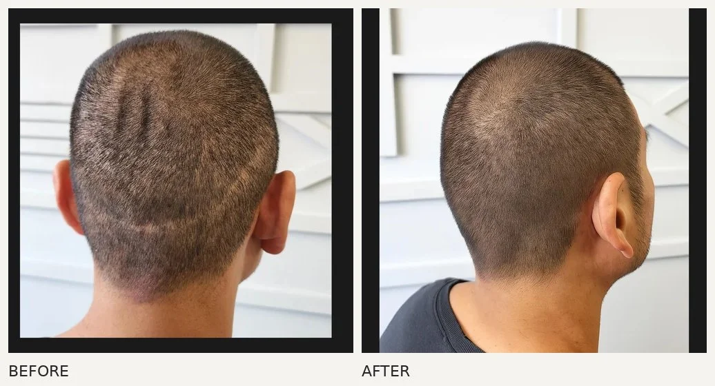 Scalp scar camouflage · Before & After