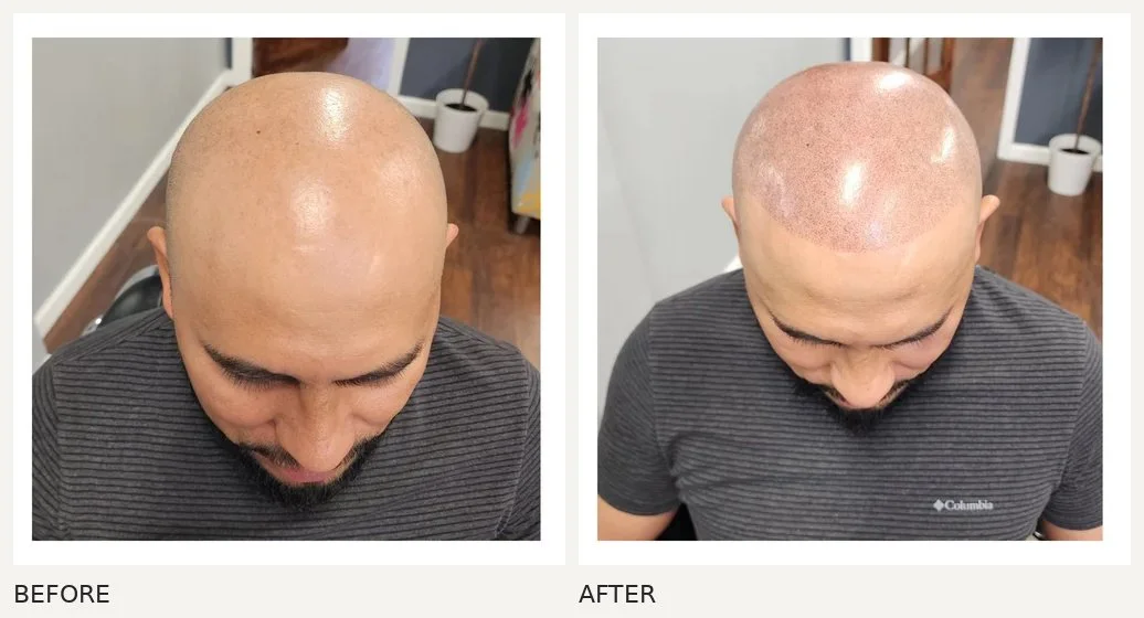 Scalp micropigmentation · Before & After