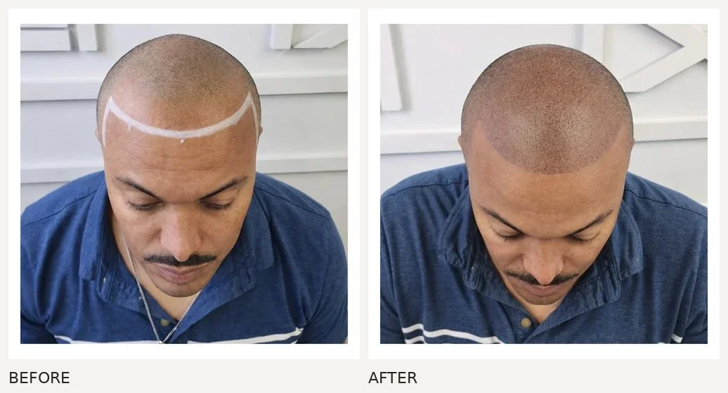 Scalp micropigmentation · Before & After