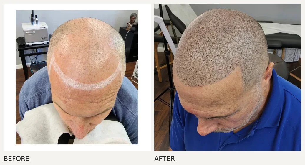 Scalp micropigmentation · Before & After