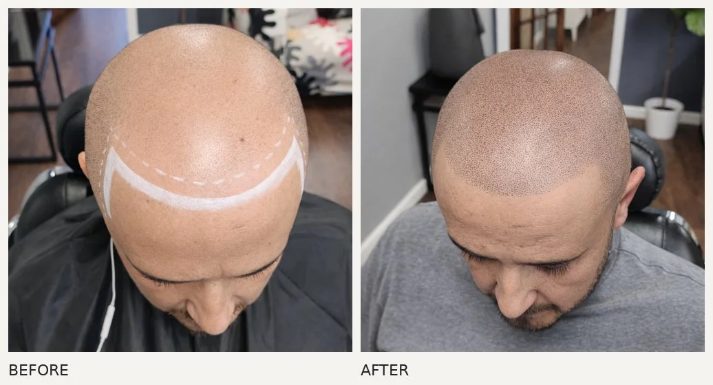 Scalp micropigmentation · Before & After