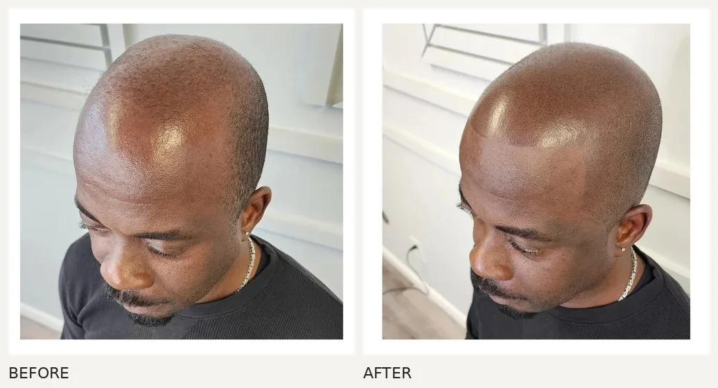 Scalp micropigmentation · Before & After