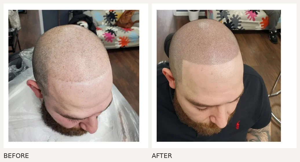 Scalp micropigmentation · Before & After