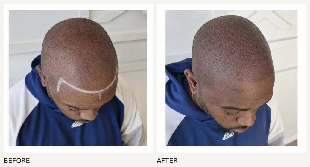 Scalp micropigmentation · Before & After