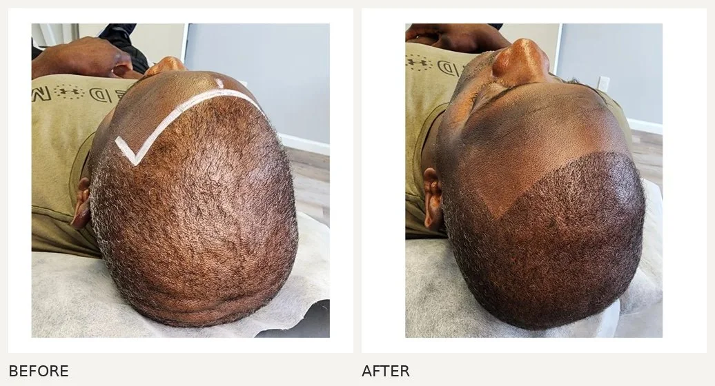 Scalp micropigmentation · Before & After
