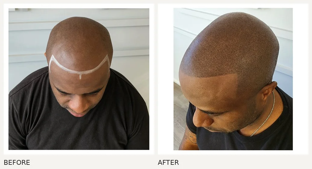 Scalp micropigmentation · Before & After