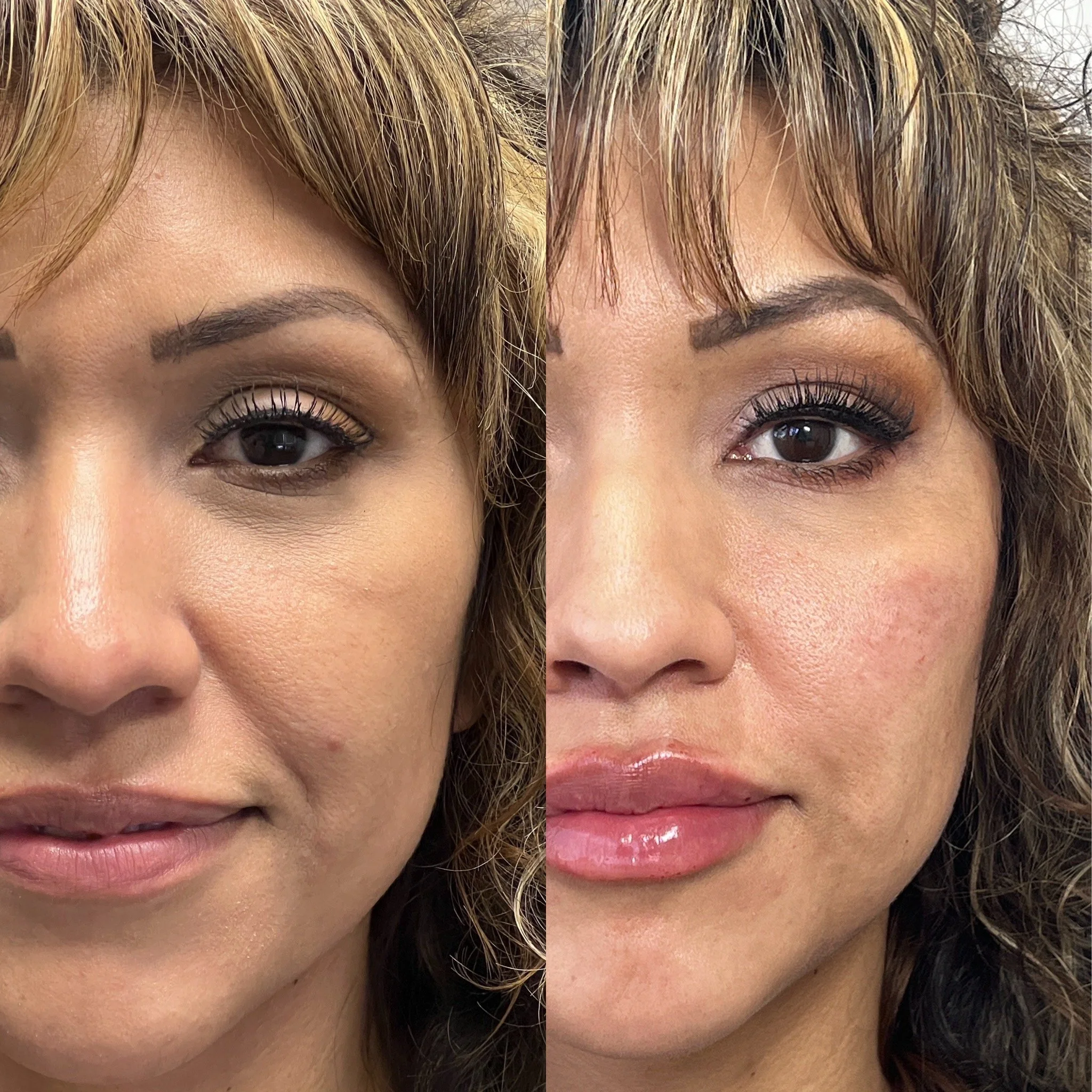 Full Face Filler