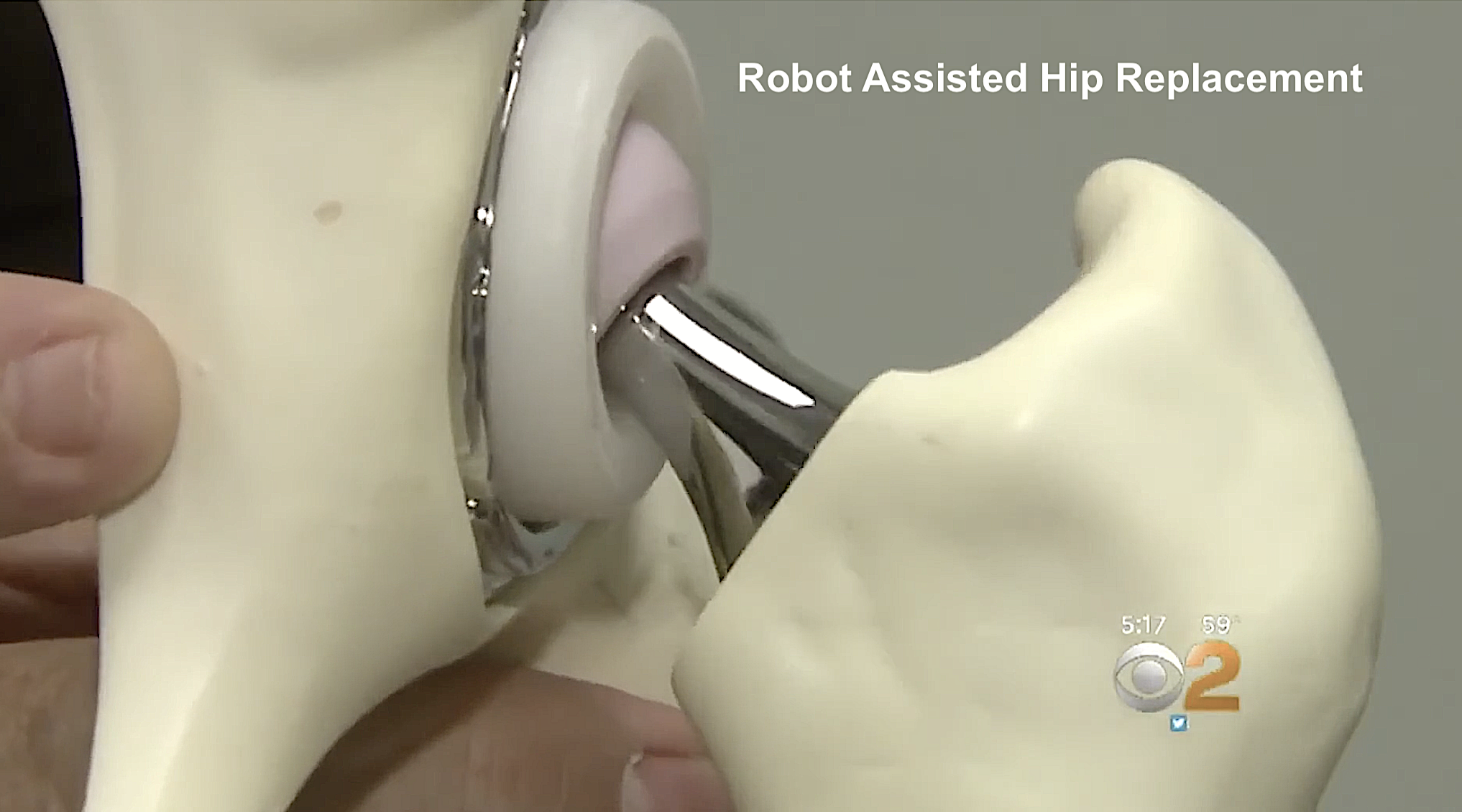 Dr. Nakul Karkare shows robotic hip replacement on CBS News, New York