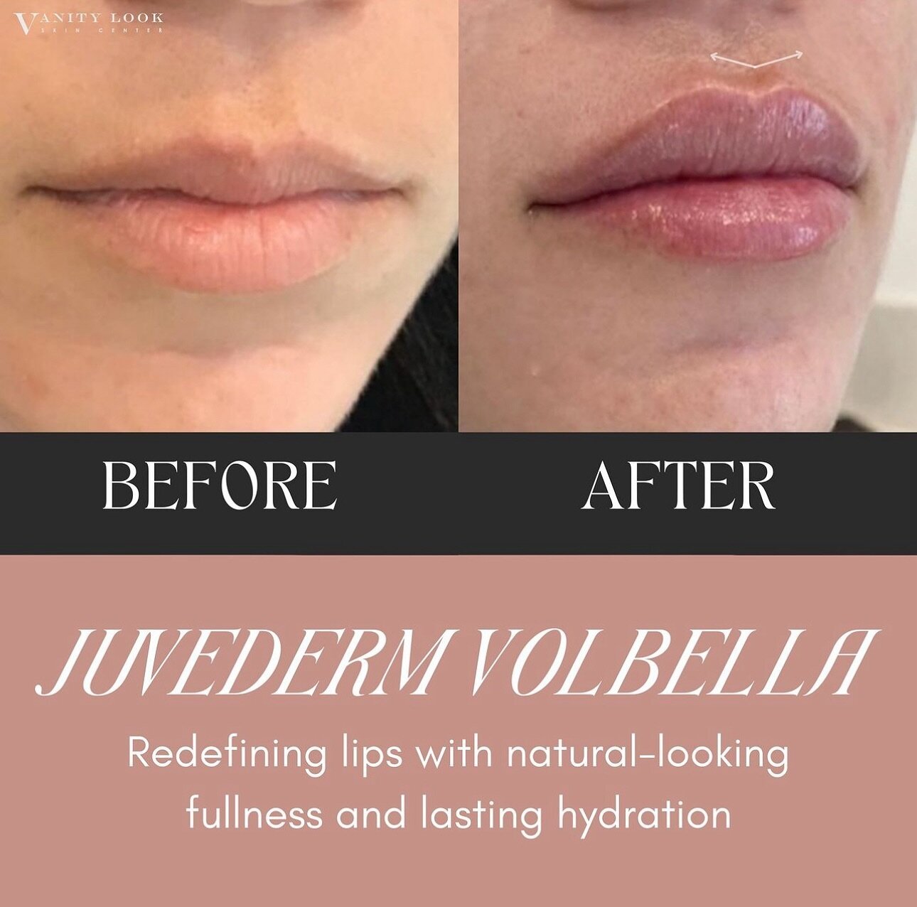 Discover the secret to beautifully enhanced lips with Juvederm Volbella! This premium hyaluronic acid-based dermal filler is expertly crafted for lip augmentation and smoothing fine lines around the mouth. Experience the art of subtle enhancement, as