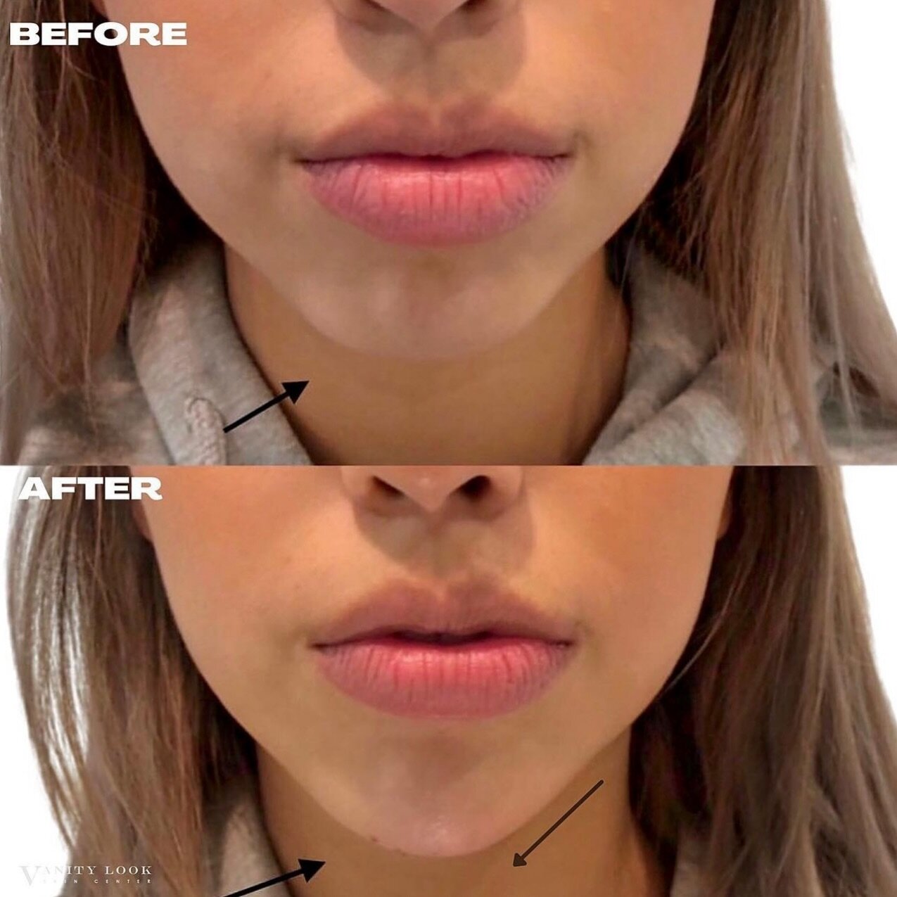 Before & After Pictures of Clients - Vanity Cosmetic Clinic