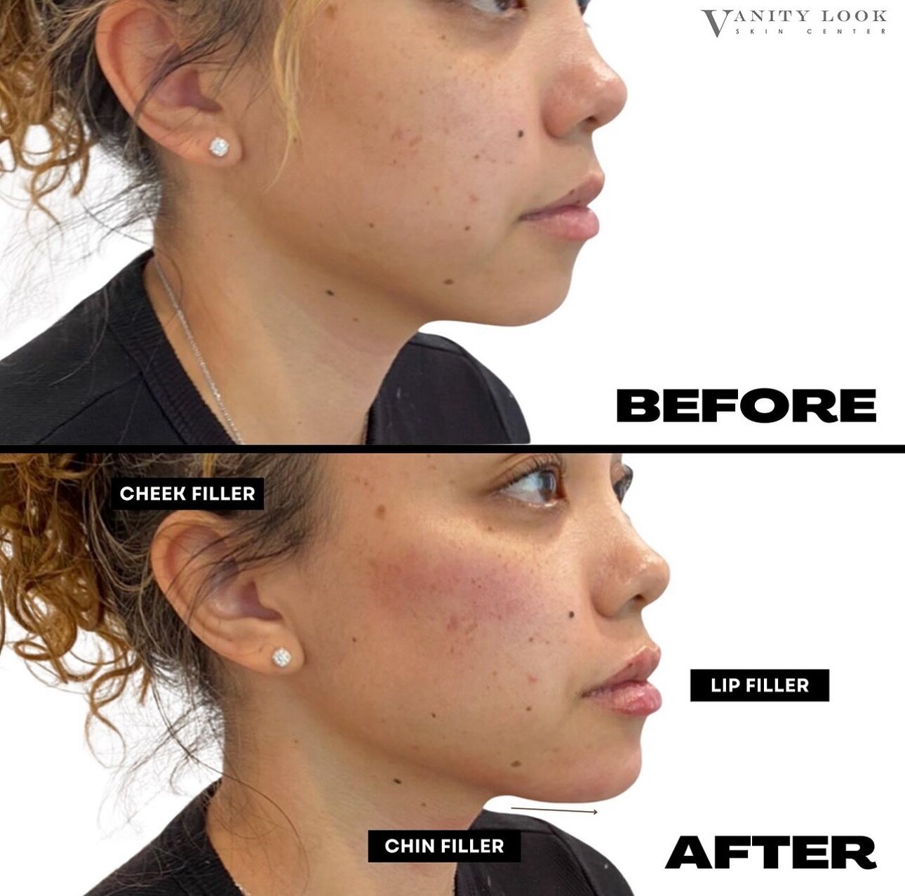 SIDE PROFILE ENHANCEMENT 💉👄 We enhanced her side profile in 15 minutes with no downtime. What do you think of this result?

Call us at (818) 290-3938 to book an appointment with one of our expert injectors! 📞✨

☎️: (818) 290-3938
💻 : Vanitylooksk