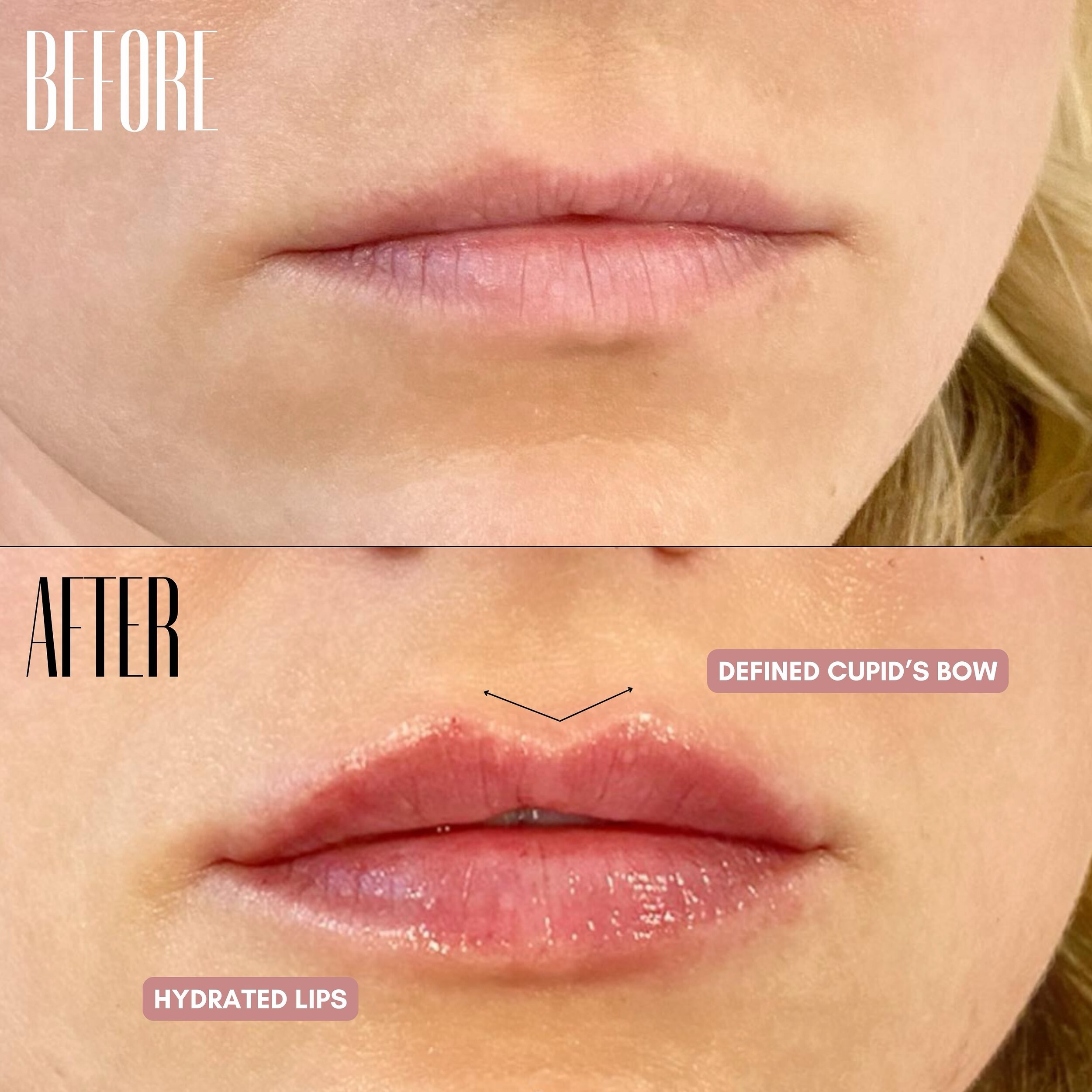 Plump lips achieved through detailed technique and the right products are essential, but what truly sets us apart is our artistic approach and our unwavering commitment to symmetry💉👄Your beauty is our canvas, and we&rsquo;re here to create a master