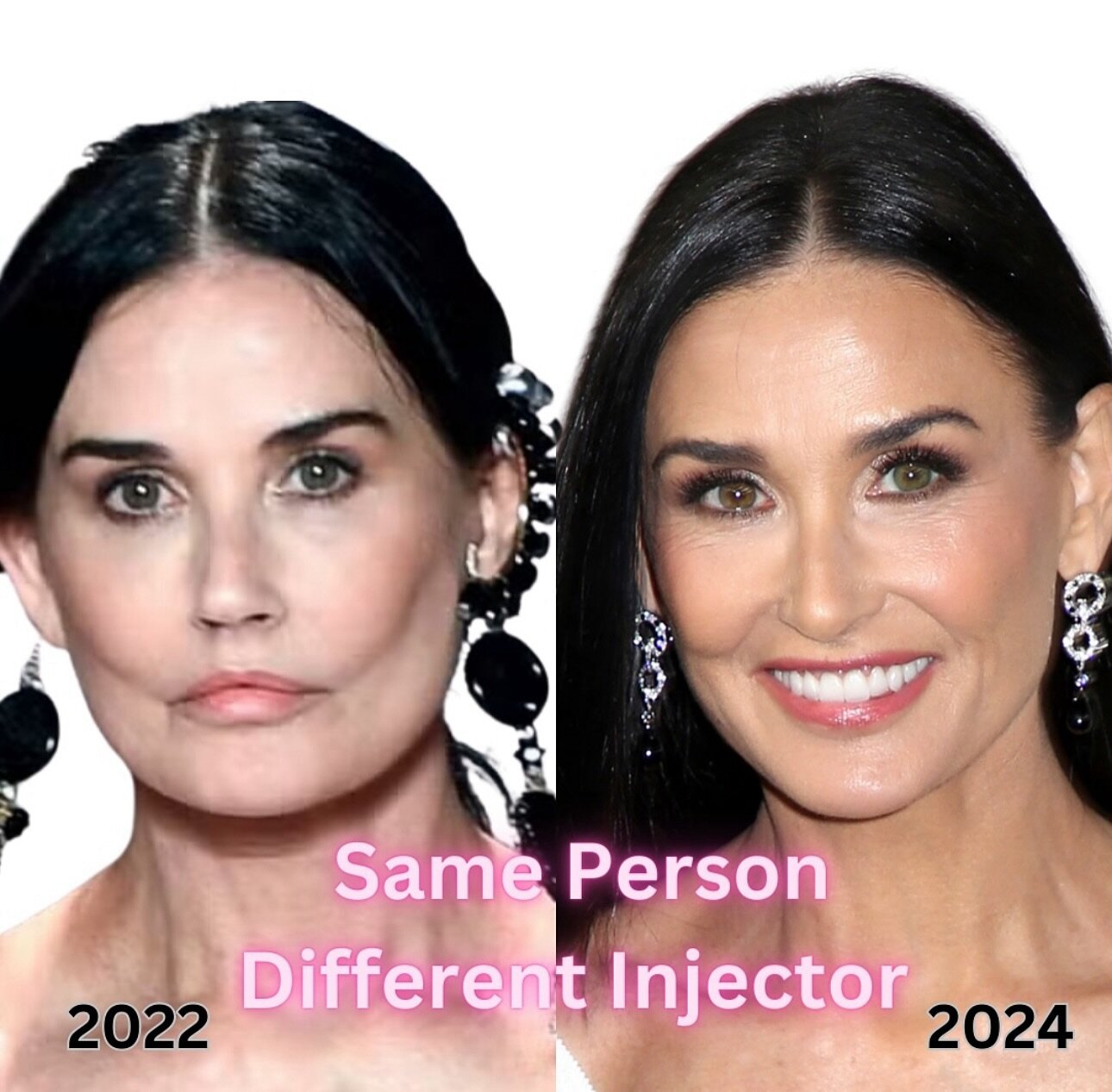 Same PERSON | Different INJECTORS! 💉👄 This is the importance of having an injector that tell you the truth and won&rsquo;t overdo it!

Services we offer:
▪️ Fillers
▪️ Anti-aging treatments
▪️ Facial Balancing
▪️ Laser Hair Removal
▪️ Skin Rejuvena