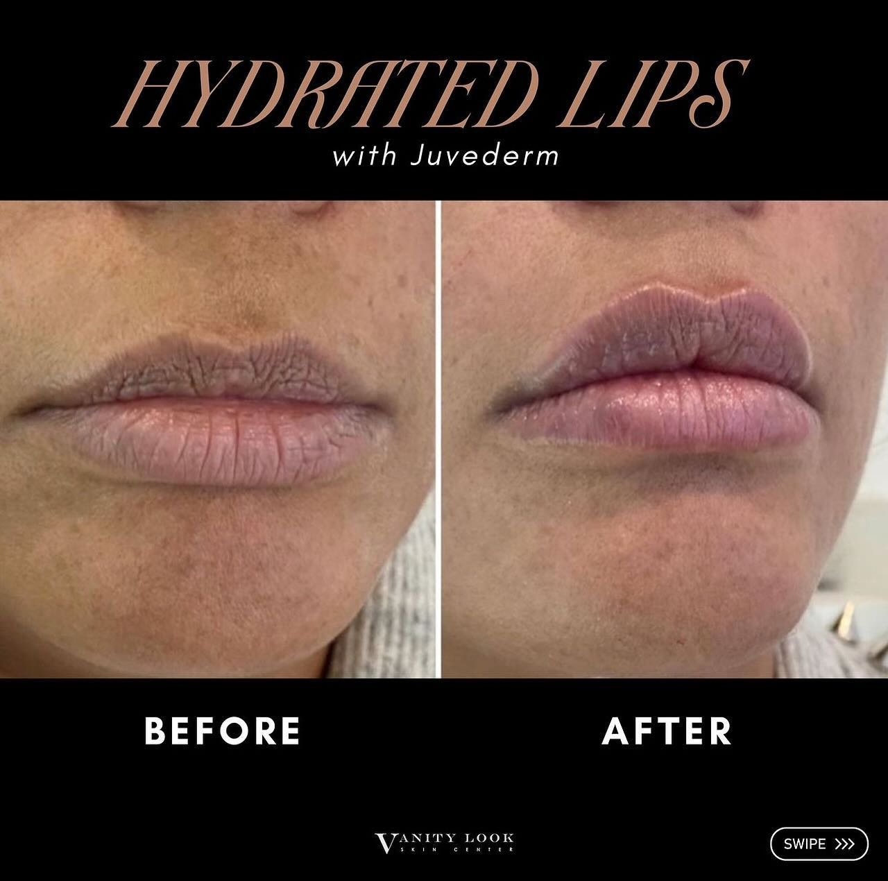 Lip perfection achieved with Juvederm! ✨ Take $75 off this filler by going to the link in our stories

To schedule an appointment, please call (818) 290-3938.

#lipfiller #lips #fillers #filler #nonsurgicalnoseaugmentation #nosefiller #rhinoplasty #v