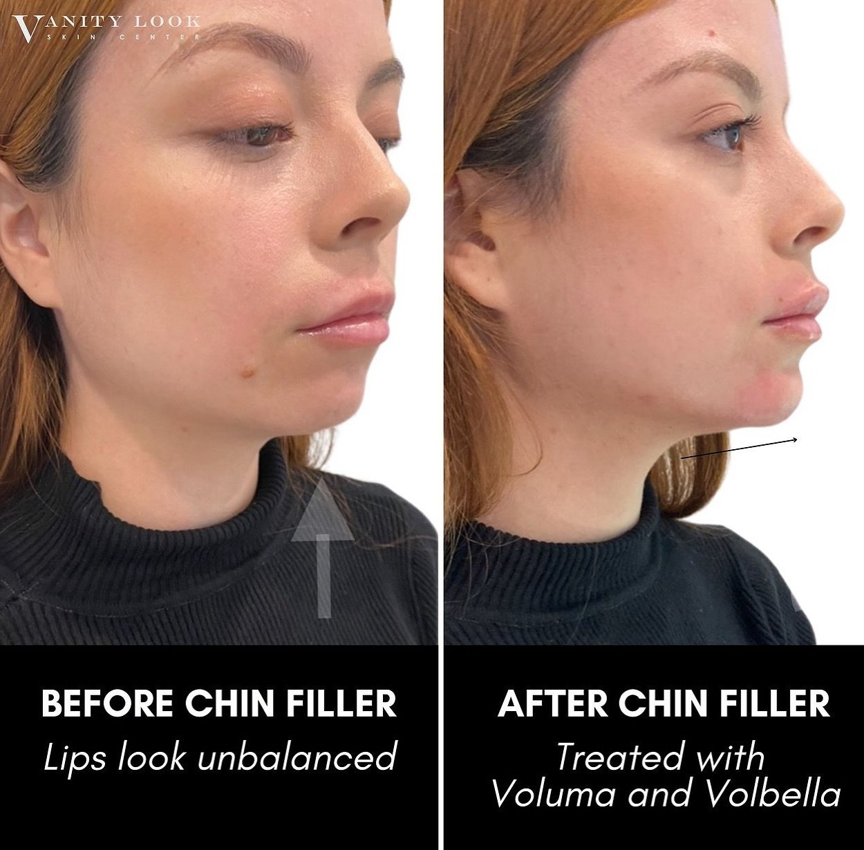Chin filler can help create a more balanced and proportional appearance for the lips by enhancing the overall harmony of the facial features. By adding volume to the chin area, the lower portion of the face becomes more defined and structured, which 