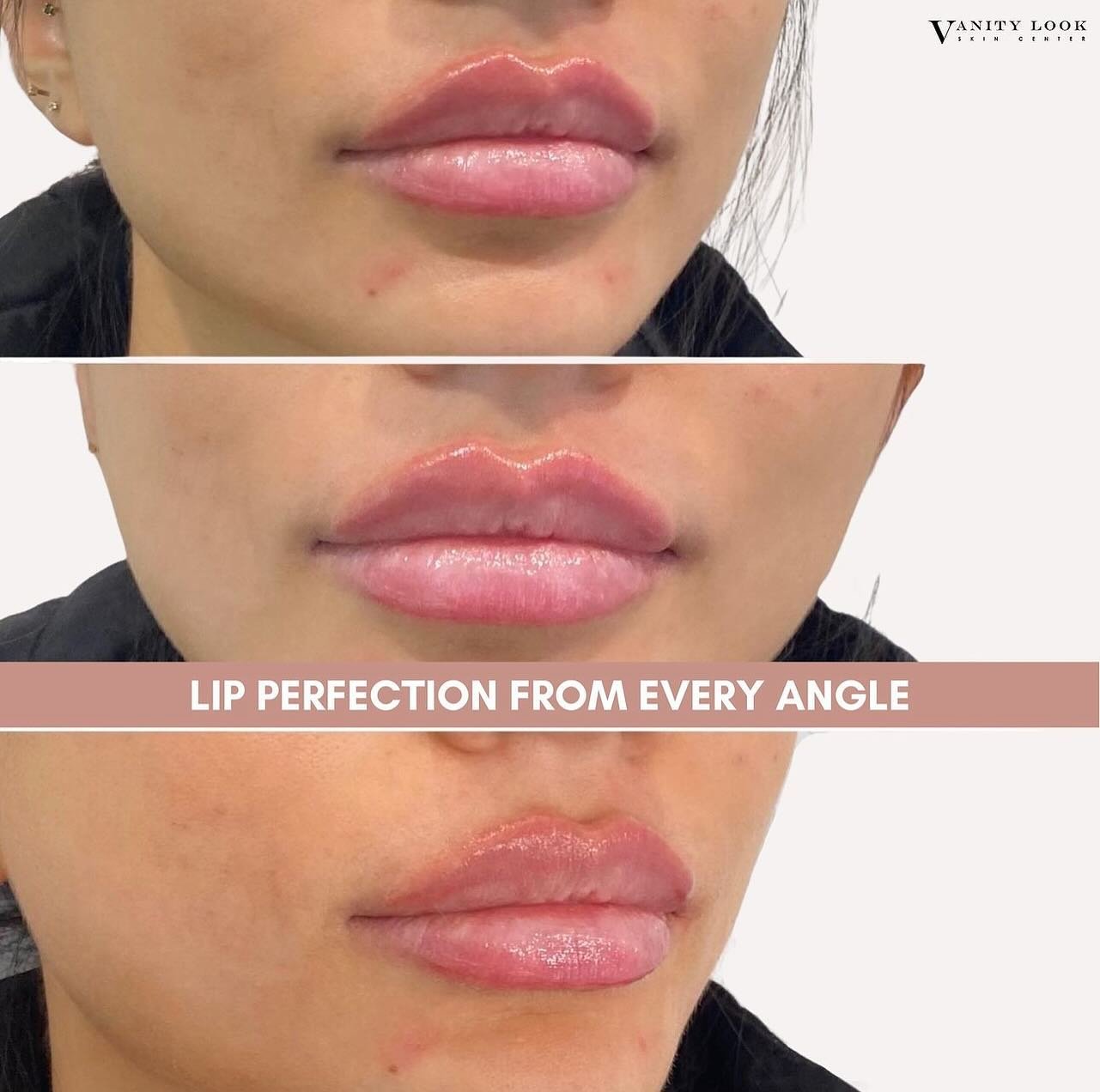 Perfection from every angle! 💉👄 Swipe to see how you can get $75 off any Juvederm filler!

📍 Vanity Look Skin Center: 

Where beauty meets expertise. Call us at (818) 290-3938 to schedule your transformation!

#lipfiller #fillers #filler #reels #r